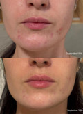 پک ۶ ساشه ای سرم میکرونیدلینگ ریدل شات کوچک کننده منافذ، تقویت بافت پوست،، صاف کننده و درخشان کننده پوست و رفع لک و جای جوش از برند Vt cosmetics